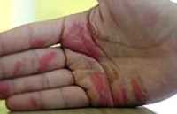 curing_hand