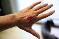 hand_avulsion_skin_tear