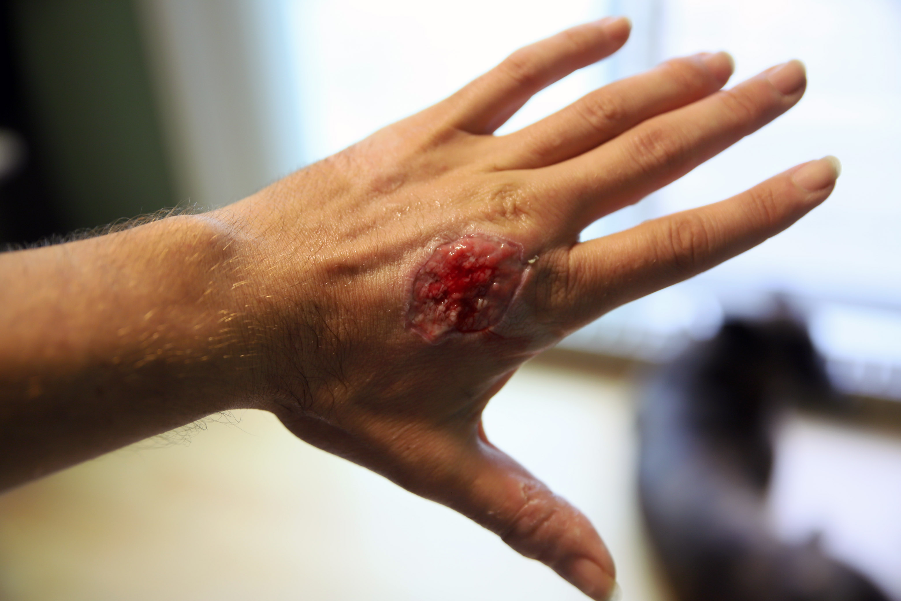 hand_avulsion_skin_tear