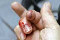 biten_hand