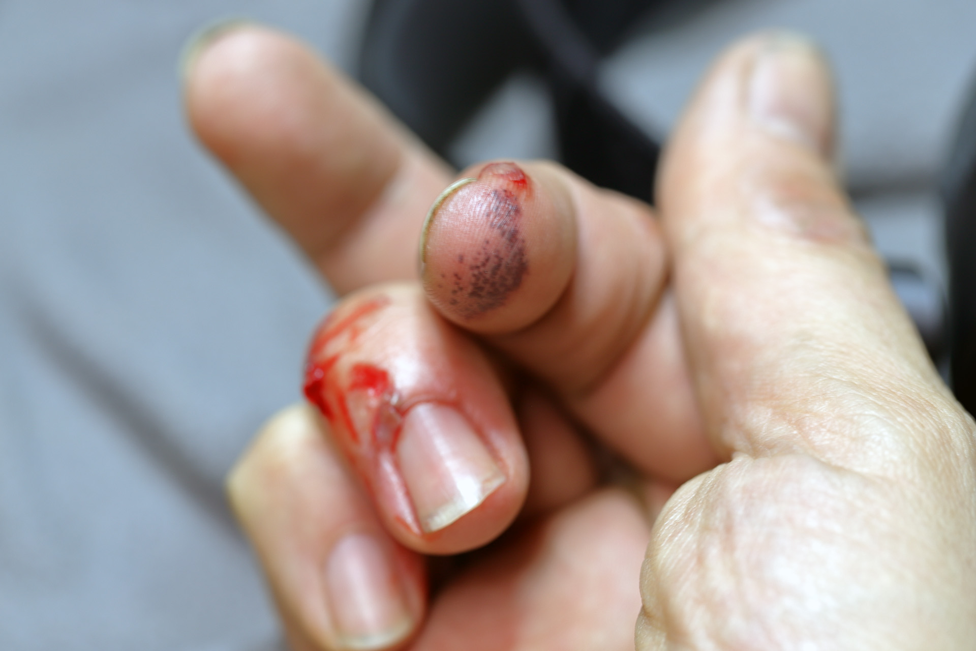 biten_hand