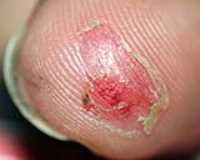 elz_finger_after_rcc