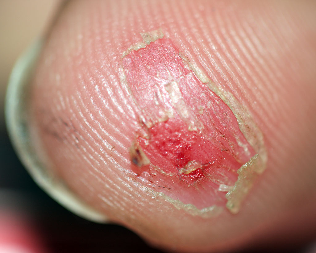elz_finger_after_rcc